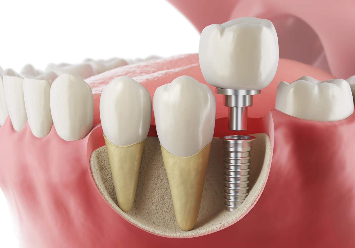 Dental Implant